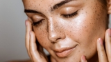 Freckles and hyperpigmentations. Love them or remove them?